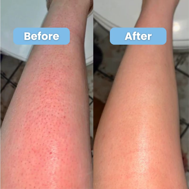 Smoothing Solution for Ingrown Hair