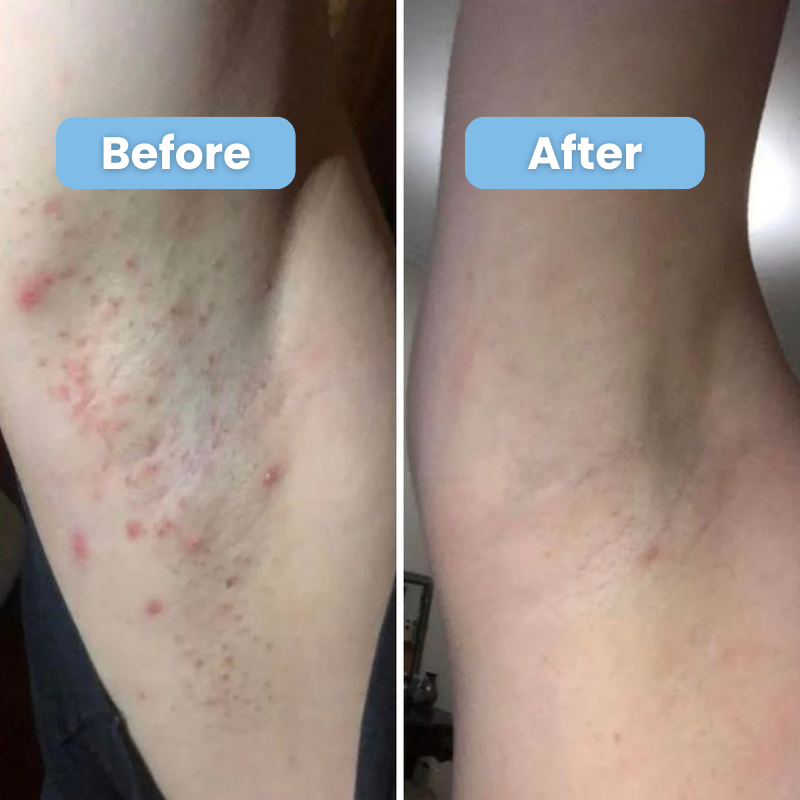 Smoothing Solution for Ingrown Hair